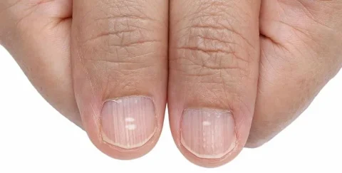 قرمز شدن هلال ناخن‌ها؛ نشانه‌ای از مشکلات جدی سلامت